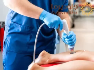 laser treatment for hair removal